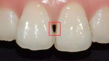 牙齿上的“黑三角”到底有多可怕？
