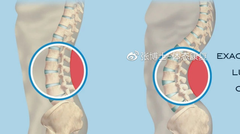 如何矫正腰椎前凸、腰椎过伸体态？