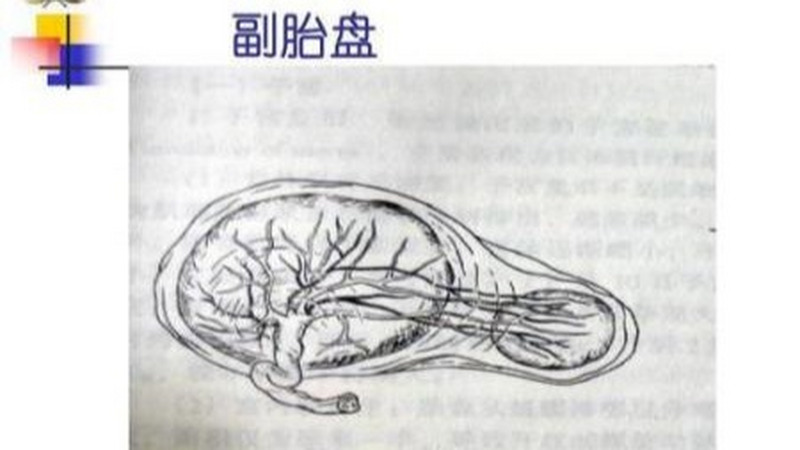 科普：产检发现单胎却有两个胎盘，这到底是怎么回事？