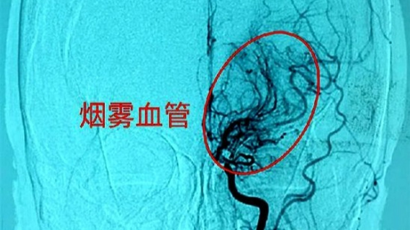 谁在脑子里喷了一口烟？“烟雾病”有哪些危害？