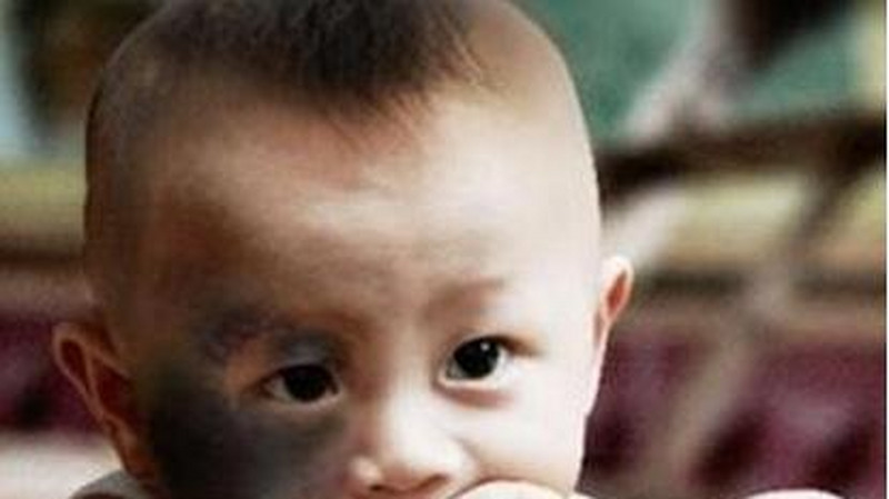发生率10%的新生儿胎记，激光是最好的治疗方案吗？